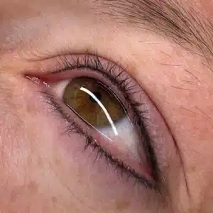 Infralash onder en boven