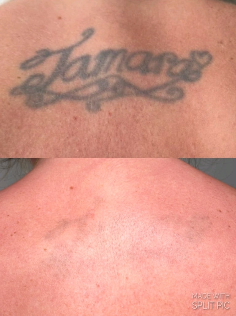 Voor en na Pico Laser tattoo verwijderen in Helmond